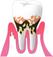 歯と歯茎のすき間4～7mm